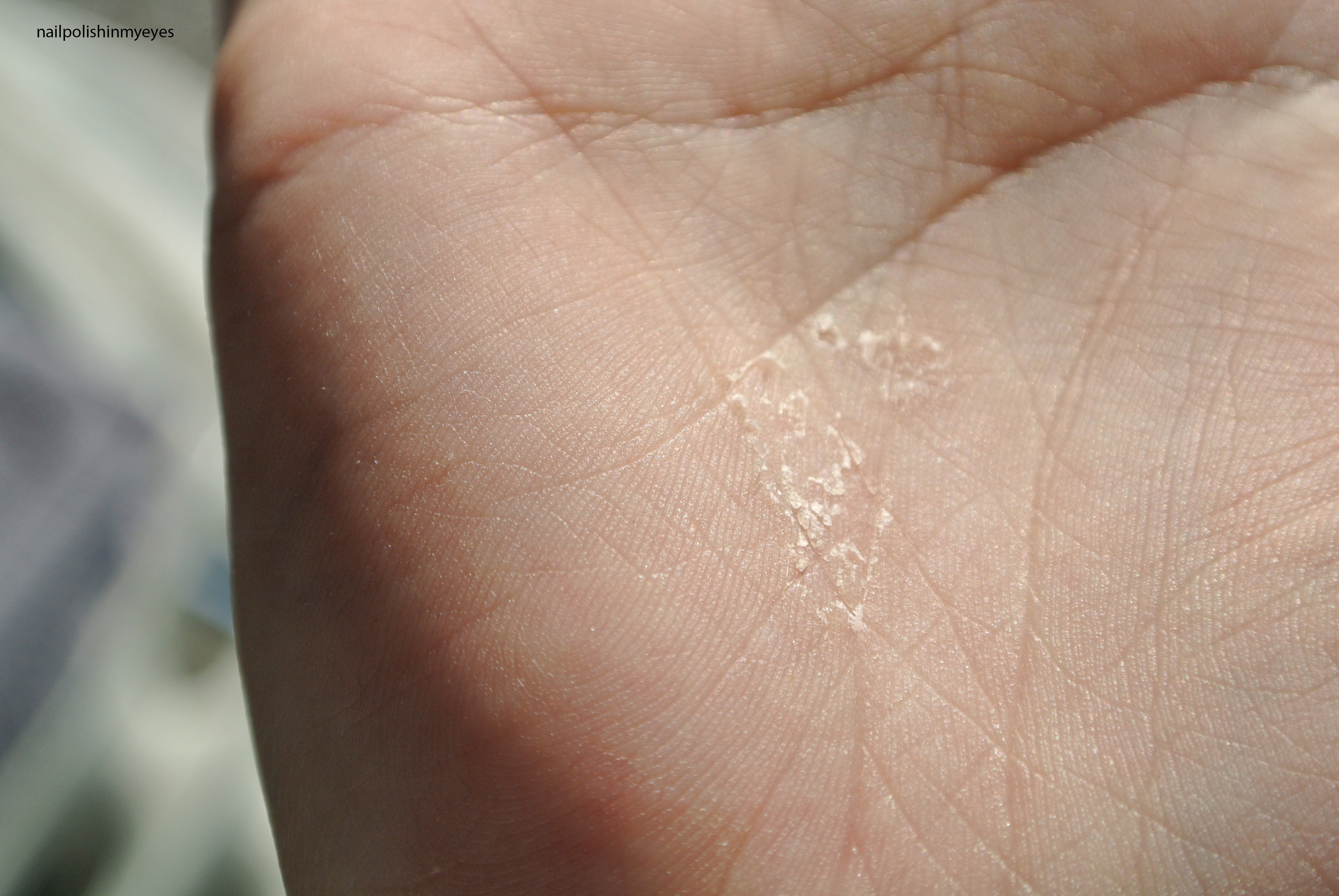 Acute palmoplantar eczema (dyshidrotic eczema) - UpToDate