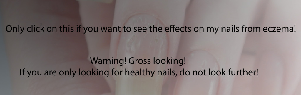 Eczema-Nails