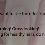 Eczema-Nails