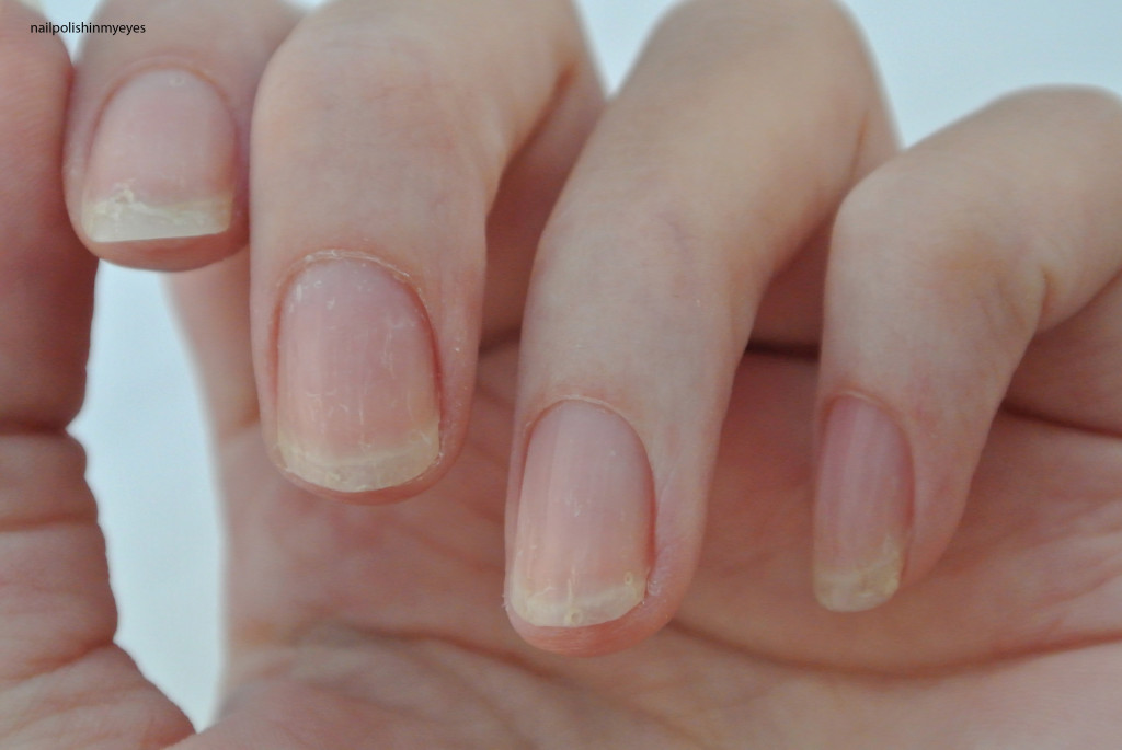 Eczema-Nails-April