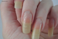 How eczema affected my nails…