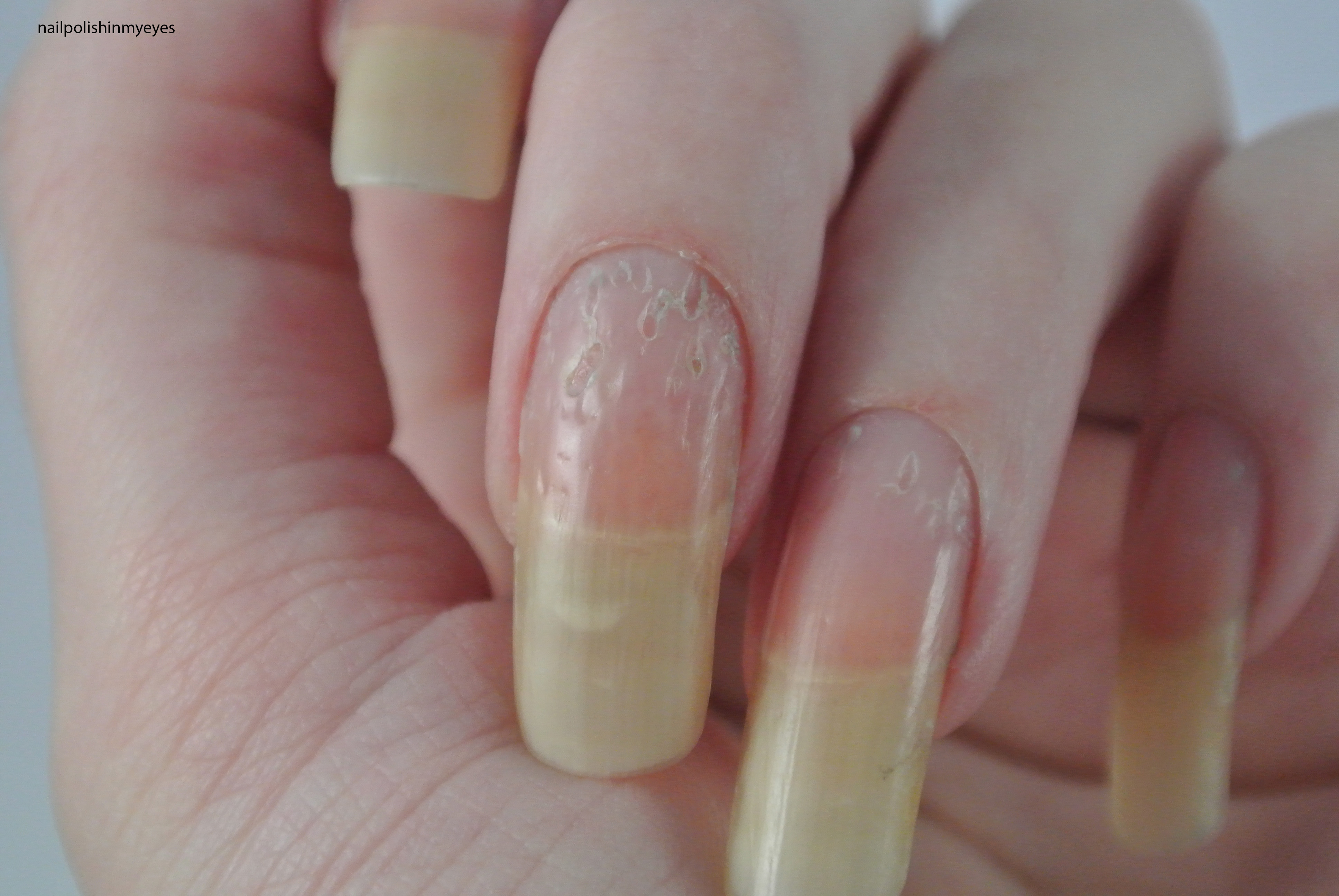 Dyshidrotic Eczema Mani Pedi