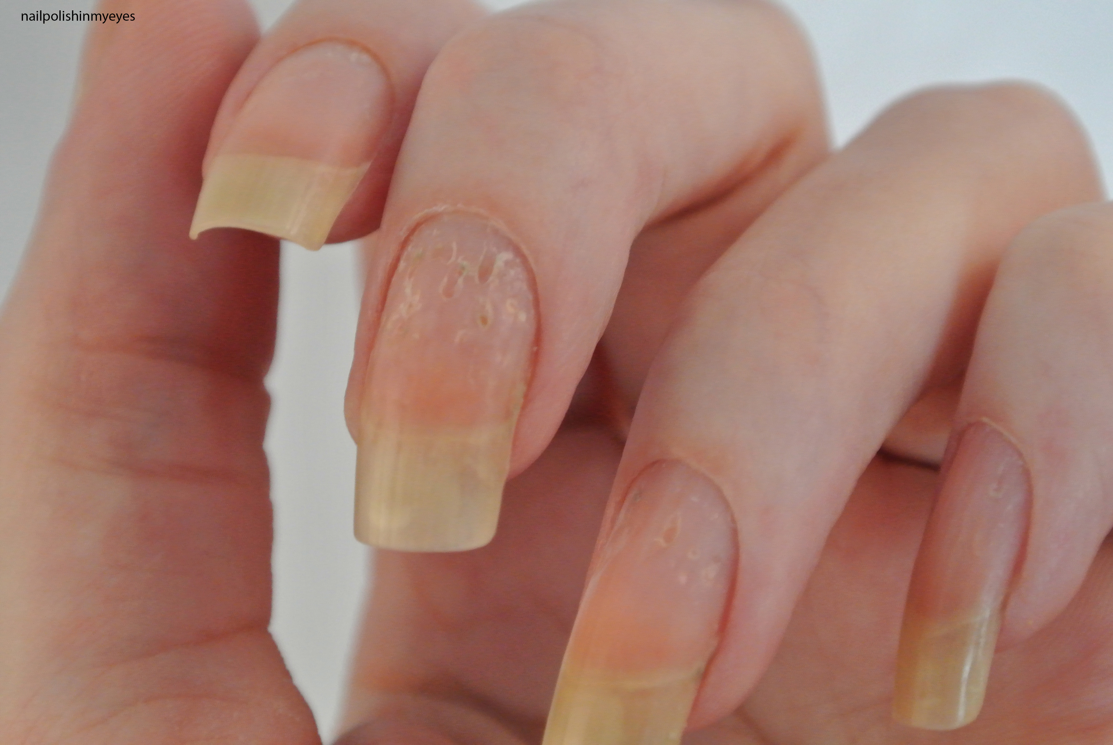 Are You Seeing Holes & Dents In Nails? Read This!