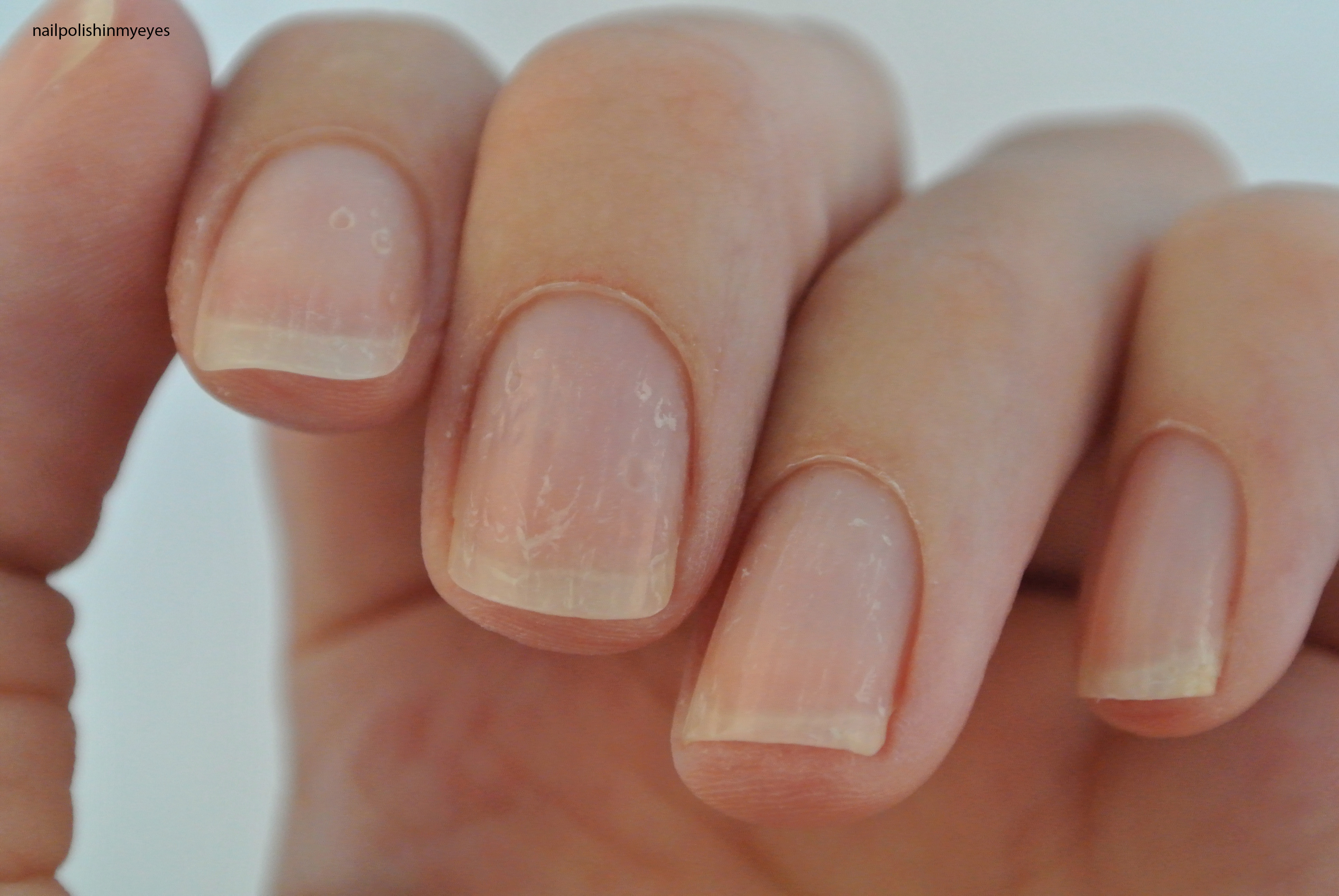 Dyshidrotic Eczema Mani Pedi