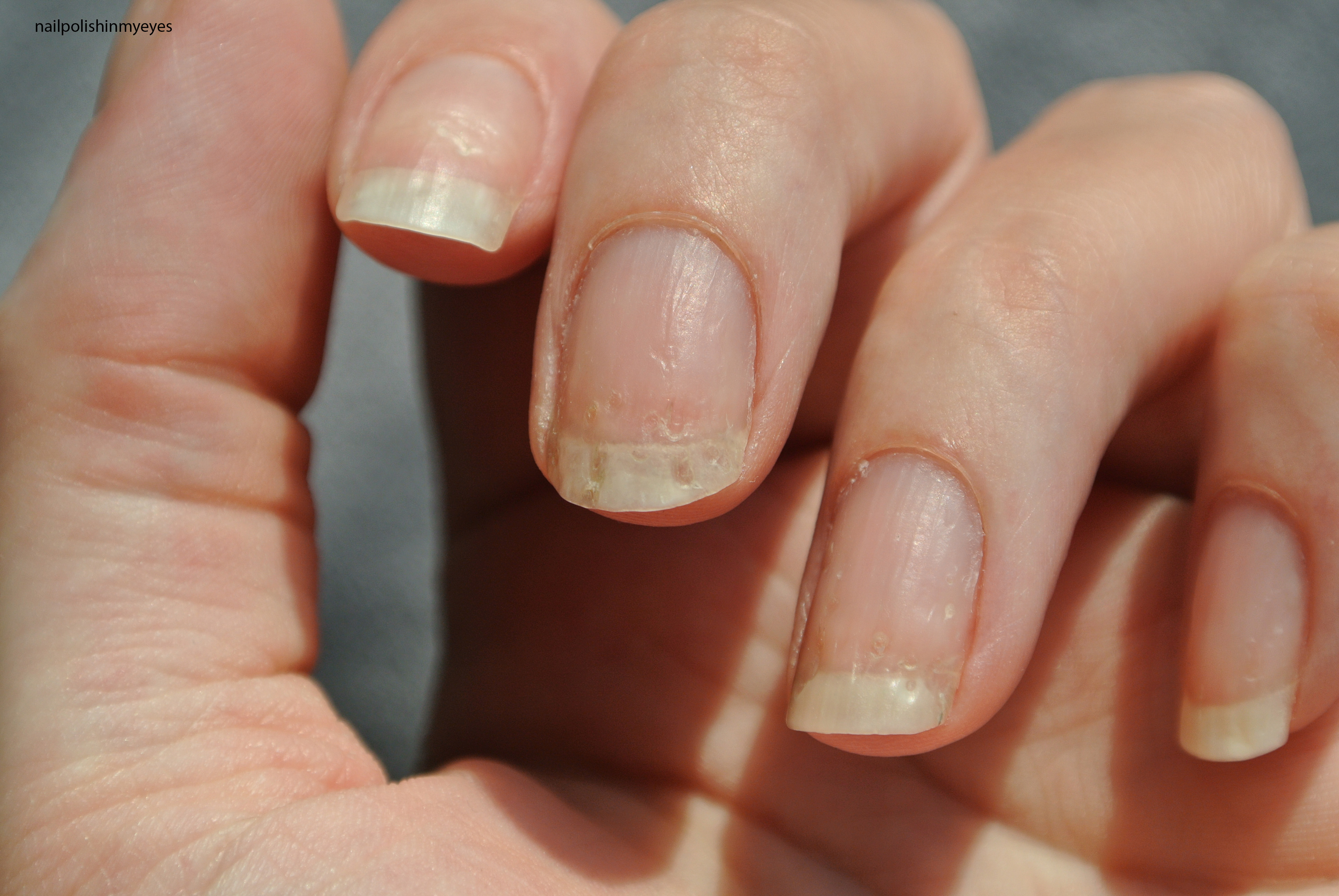 How Eczema Affected My Nails Nail Polish In My Eyes
