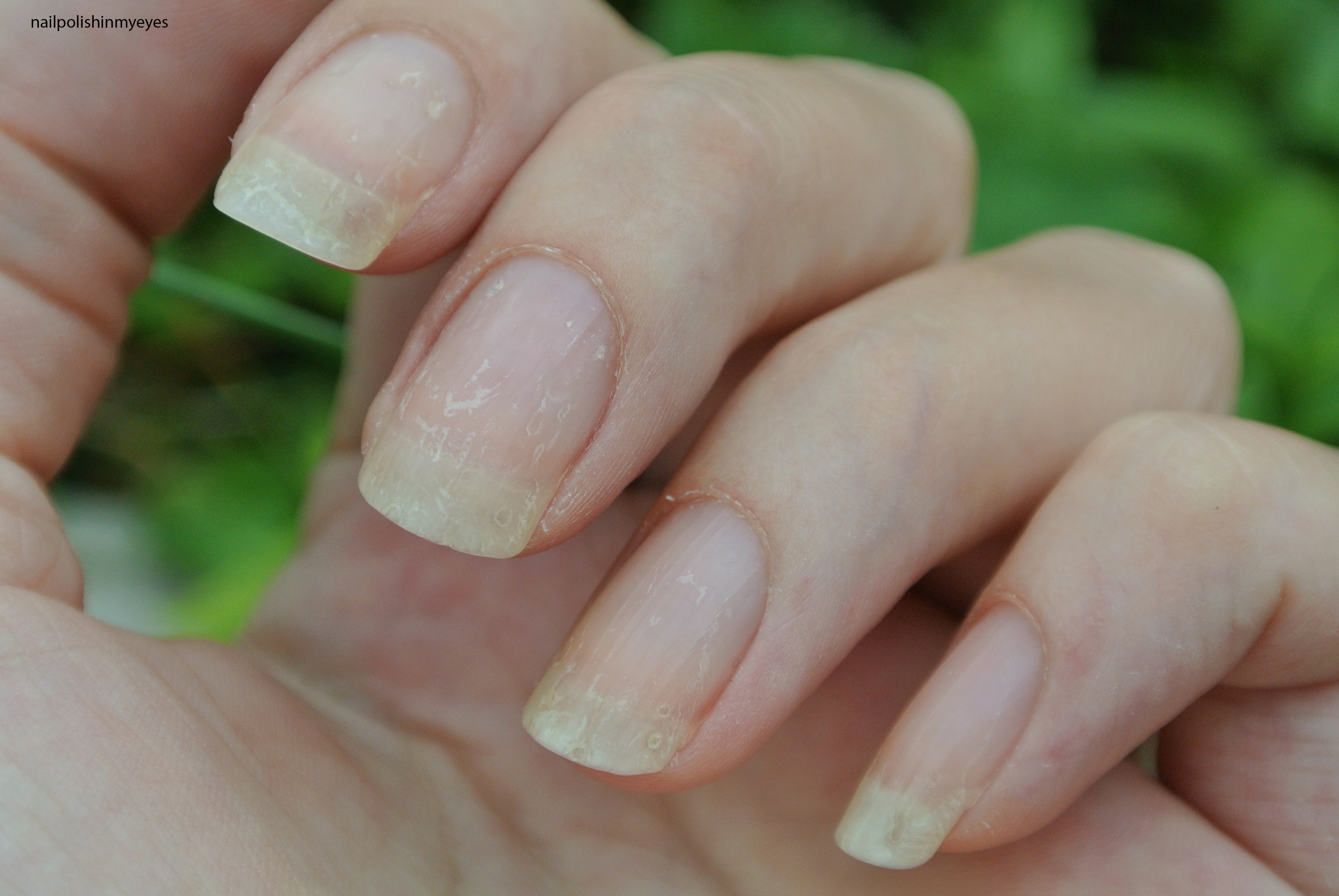 Structure of Nails And Nail Disorders